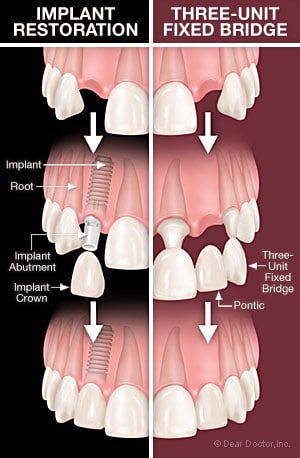Implants Bridgework Teeth Tooth Dr. Karen Whitten Dentistry Dentist Near Me Premiere Omaha Nebraska Dental Before After