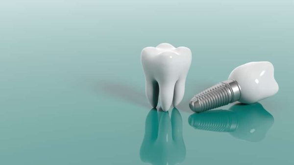 4 Tips To Take Care Of Your Tooth Implants